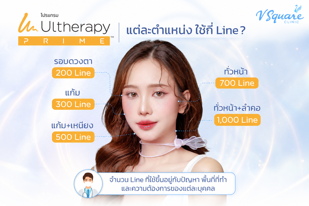 Ulthera Prime แต่ละตำแหน่งราคา