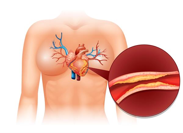 รู้ทัน “โรคหลอดเลือดหัวใจ” ภัยเงียบที่น่ากลัว แนะ 7 วิธี ดูแลสุขภาพหัวใจให้แข็งแรง