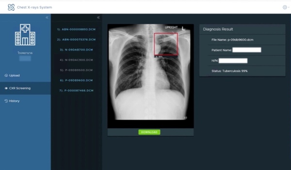 'INET’ จับมือ 'IBM’ นำ AI ช่วยตรวจหาวัณโรคจากภาพเอ็กซเรย์ทรวงอกในโรงพยาบาล 75 แห่งทั่วไทย