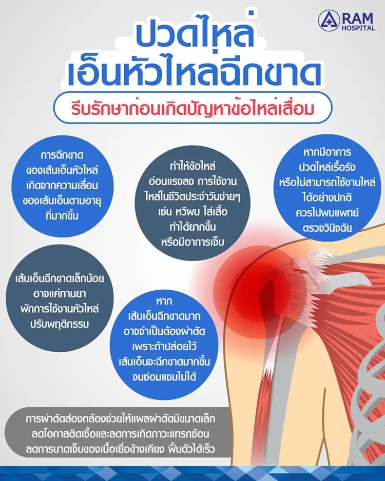ปวดไหล่เอ็นหัวไหล่ฉีกขาด รีบรักษาก่อนเกิดปัญหาข้อไหล่เสื่อม