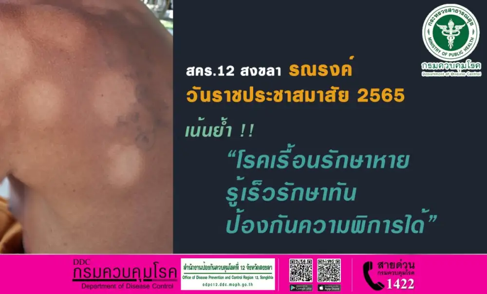 สคร.12 สงขลา รณรงค์วันราชประชาสมาสัย 2565 เน้นย้ำ โรคเรื้อนรักษาหาย รู้เร็วรักษาทัน ป้องกันความพิการได้