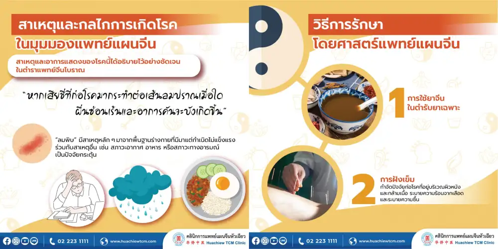 ลมพิษ ผื่นลม ผื่นซ่อนเร้น โรคผิวหนังเรื้อรังที่เป็นซ้ำแล้วซ้ำอีก