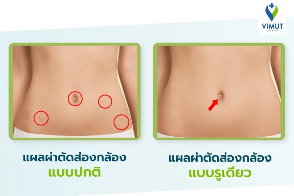 หมดกังวลเรื่องผ่าตัด! ทำความรู้จัก