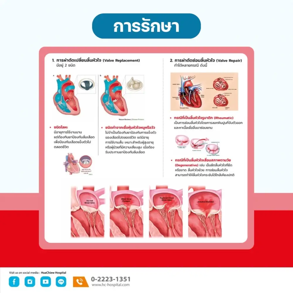 การผ่าตัดลิ้นหัวใจรั่ว