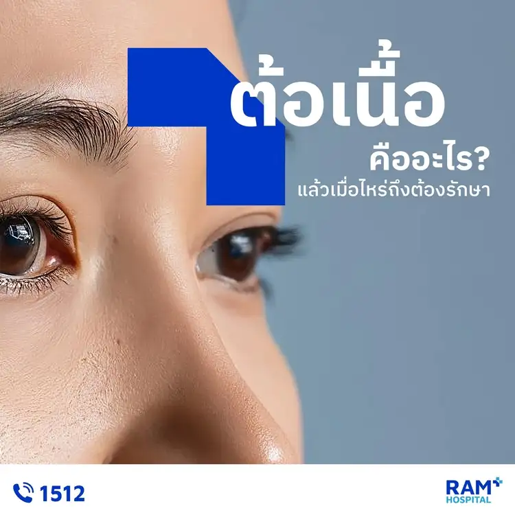 ต้อเนื้อคืออะไร?... แล้วเมื่อไหร่ถึงต้องรักษา?