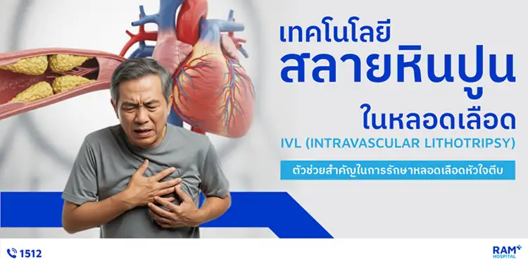 IVL เทคโนโลยีสลายหินปูนในหลอดเลือด ตัวช่วยสำคัญในการรักษาหลอดเลือดหัวใจตีบ