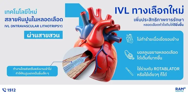 IVL เทคโนโลยีสลายหินปูนในหลอดเลือด ตัวช่วยสำคัญในการรักษาหลอดเลือดหัวใจตีบ