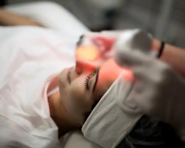 วีบีม เลเซอร์ (Vbeam Laser) รักษารอยแดงจากสิว ทำแล้วผิวบางจริงไหม