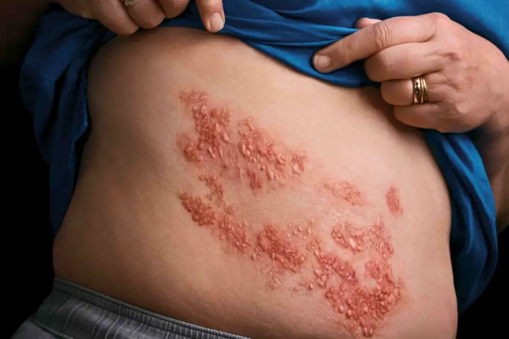 แพทย์ชี้ '1 ใน 3 คน' เสี่ยงเป็นงูสวัดอย่างน้อย 1 ครั้งในชีวิต วัย 50+ และผู้มีโรคร่วม เสี่ยงกระทบสุขภาพรุนแรง