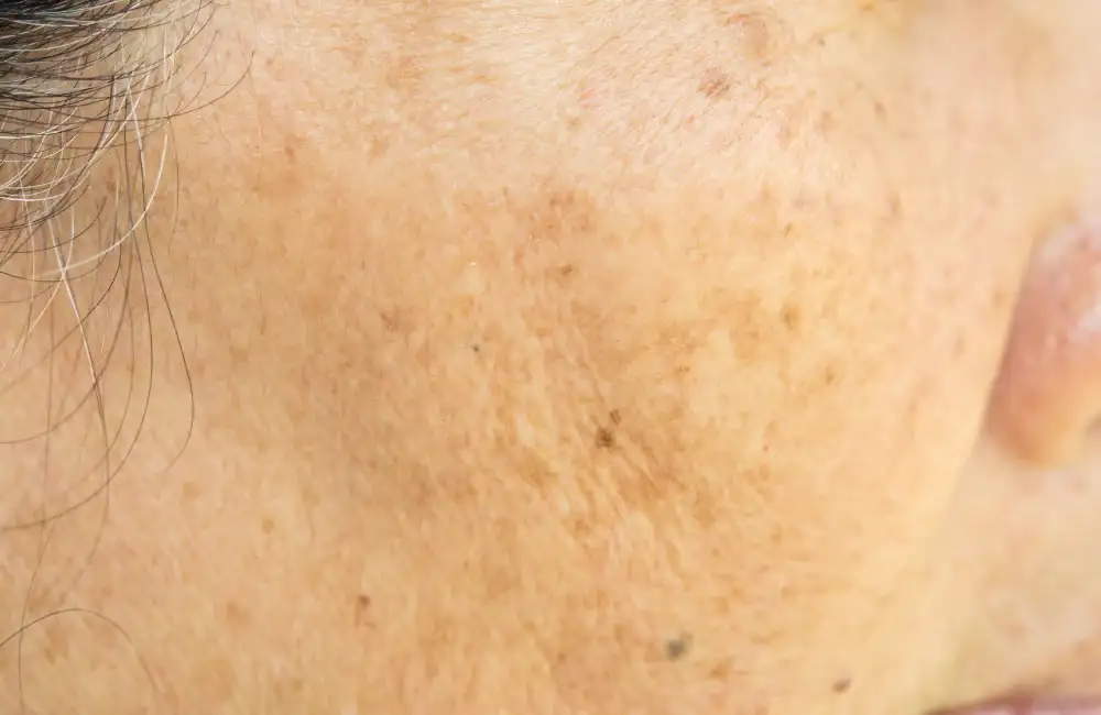 แนะนำวิธีดูแลปัญหาฝ้ากระลึกและฝ้าเลือดด้วยโปรแกรมเลเซอร์ที่ BSL Clinic