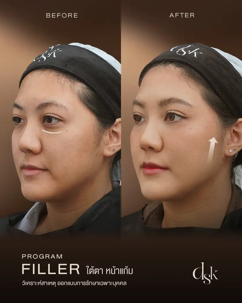 ฉีดโปรแกรมฟิลเลอร์ที่ไหนดี รู้จักประเภทของสารเติมเต็ม วิธีเช็กของแท้ และเกณฑ์เลือกคลินิก